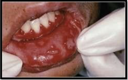 <p>what is this lesion</p>