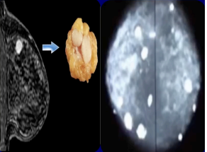 <p>The mammography shows what lesion</p>