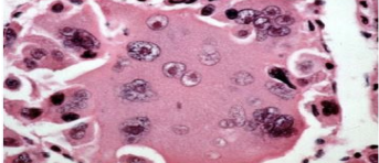 <p>Large anaplastic cells, may be bi- or multinucleated giant cells or clear cell type. Stroma is scanty and poorly vascular.</p>