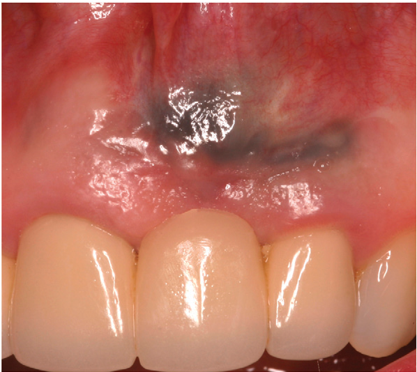 <p>What is this lesion?</p>
