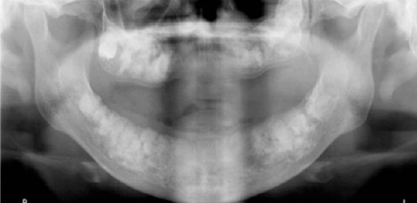 <p>florid cemento-osseous dysplasia </p>