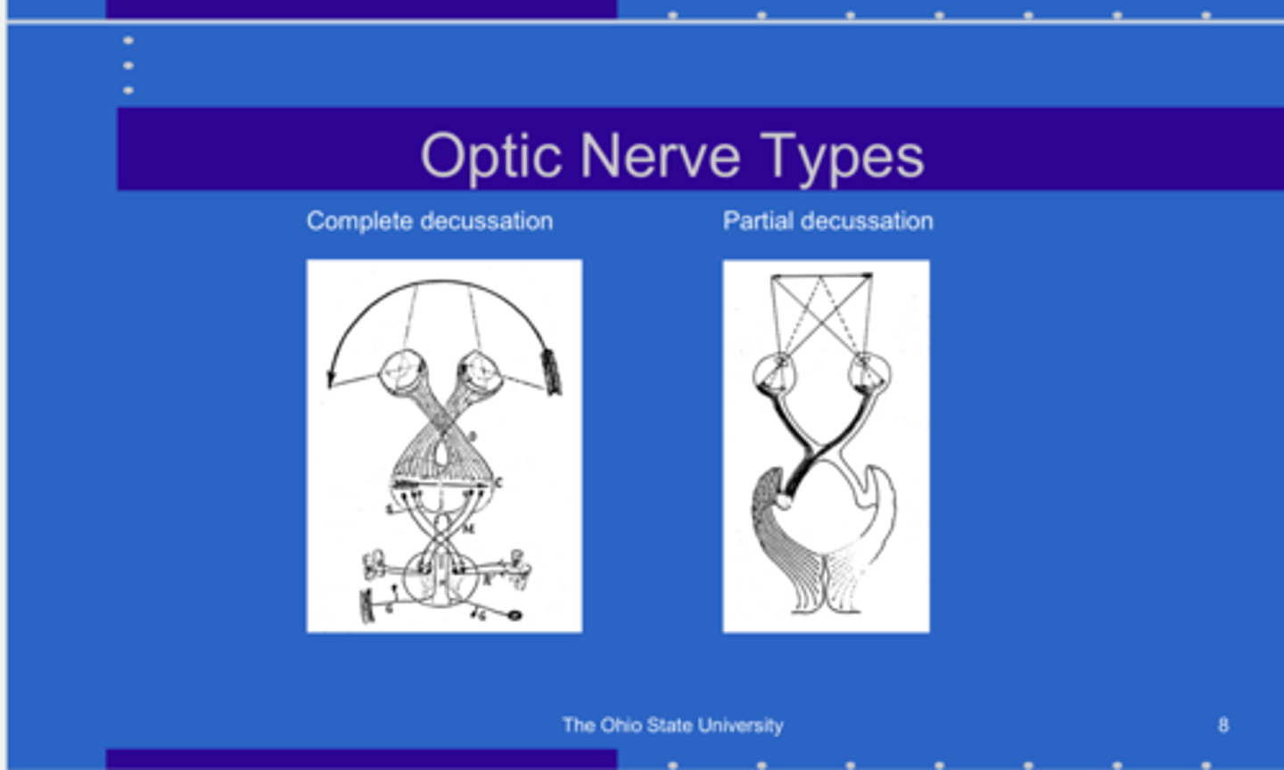 <p>Optic Nerve Types -- Complete Decussation and Partial Decussation (Pic)</p>