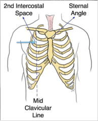 <p>DO NOT delay treatment for CXR!!!</p><p>Treatment: Needle Decompression</p><p>- Rapidly insert large bore (14g) needle into the 2nd ICS in the mid-clavicular line of the effected side (just inferior to clavicle)</p><p>- Keep catheter in place until a surgical chest tube has been inserted</p><p>- Once decompressed, then obtain CXR</p>