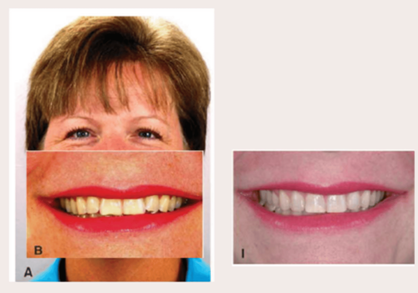 <p>What is affecting the esthetics?</p>
