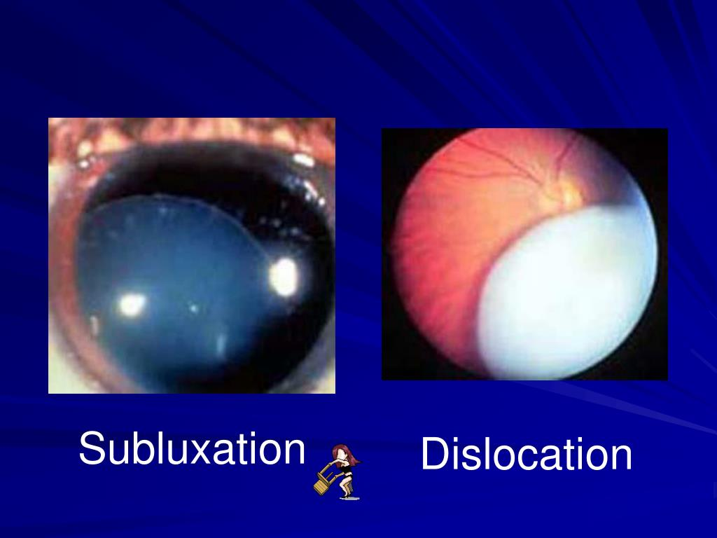 <p>Lens Dislocation (Luxation) AKA ectopia lentis: This occurs when the lens is completely displaced from its normal position, either into the anterior chamber or into the vitreous cavity. The lens is no longer in the pupillary area and is free-floating or positioned abnormally. marfan &amp; homocystinuria</p><p>Lens Subluxation: This condition involves a partial displacement of the lens, where it remains within the pupillary area but is not centered. marfan, EDS</p>
