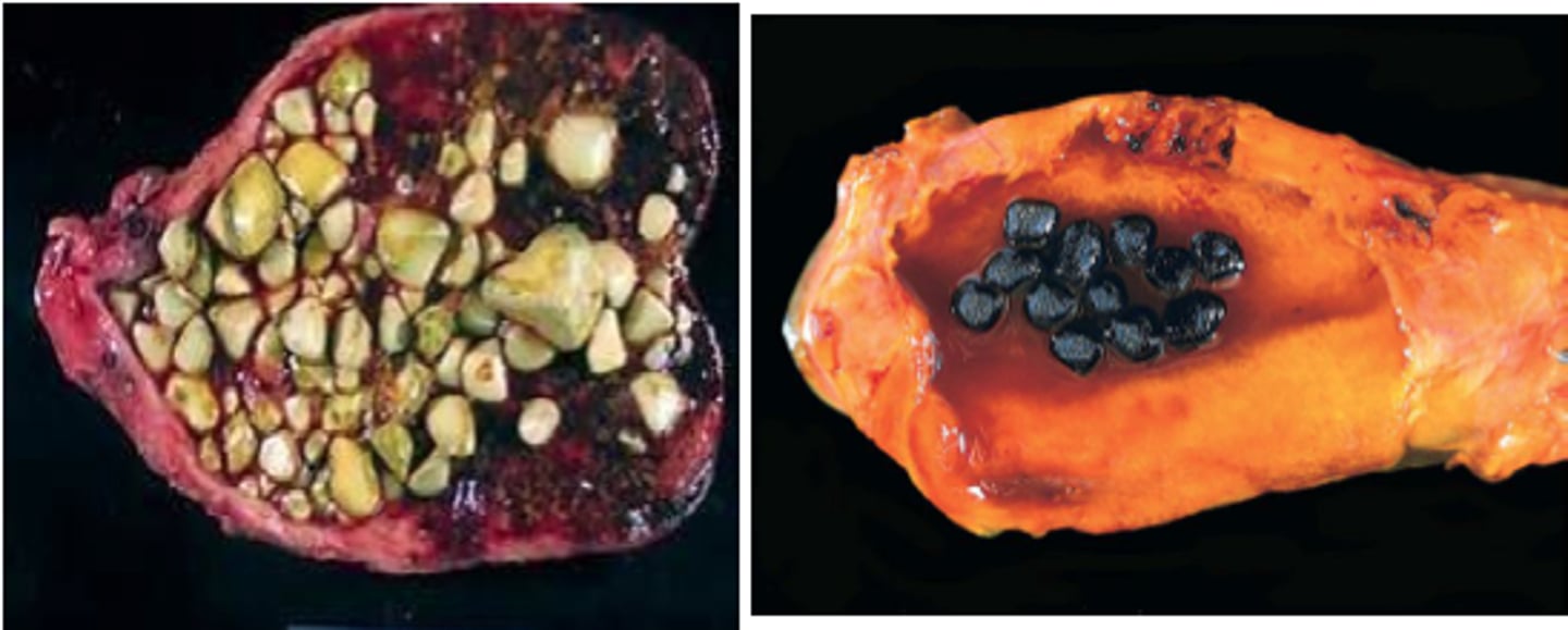 <p>Cholesterol rocks formed in the bile, blocks the bile ducts</p>