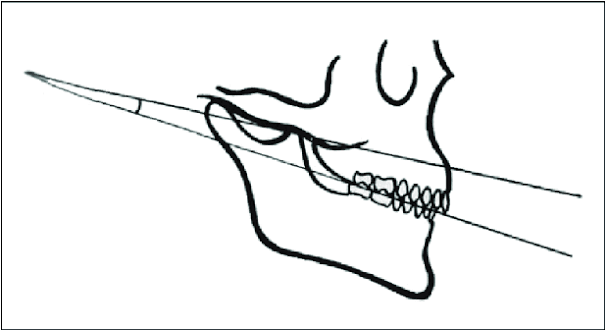 <p>imaginary surface of where the upper and lower teeth meet when biting down</p>