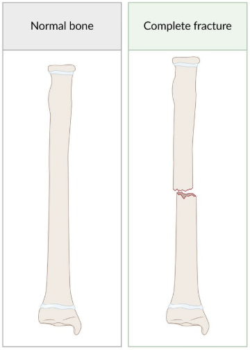<p>Complete: Fracture line through entire bone</p><p>Incomplete: Fracture line not through entire bone</p>