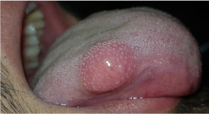 <ul><li><p>benign neural tumor of shwann cell origin</p></li><li><p>uncommon, but often involved the head and neck</p></li><li><p>young and middle aged adults</p></li><li><p>slow growing</p></li><li><p>variable symptoms</p></li><li><p>oral tumors most commonly involve the tongue and may arise within the bone, causing an expansile, unilocular radiolucency </p></li></ul><p></p>