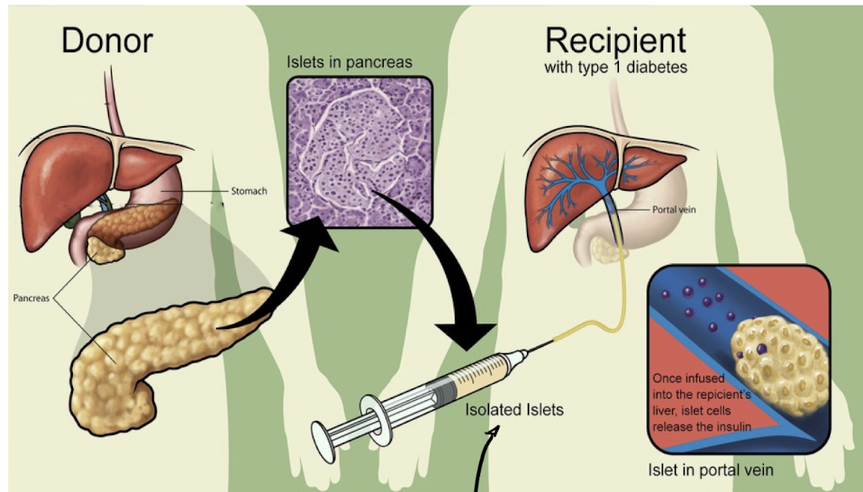 <ul><li><p>take beta islets from donor → inject into liver instead of pancreas so WBCs cant kill them </p></li></ul><p></p>