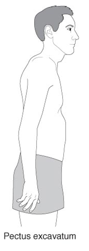 <p>pectus excavatum </p>