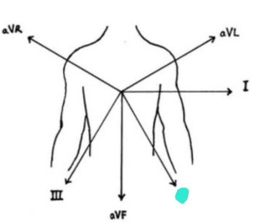 <p>right arm &amp; left leg 흘러가는 전기적 흐름 보여줌</p>