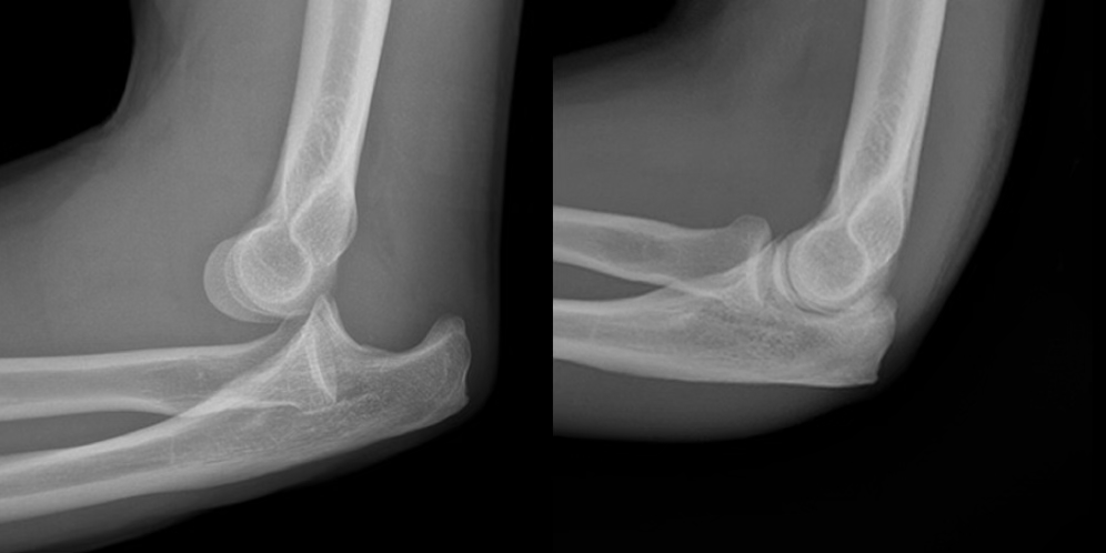 <p>symptoms of elbow dislocation</p>