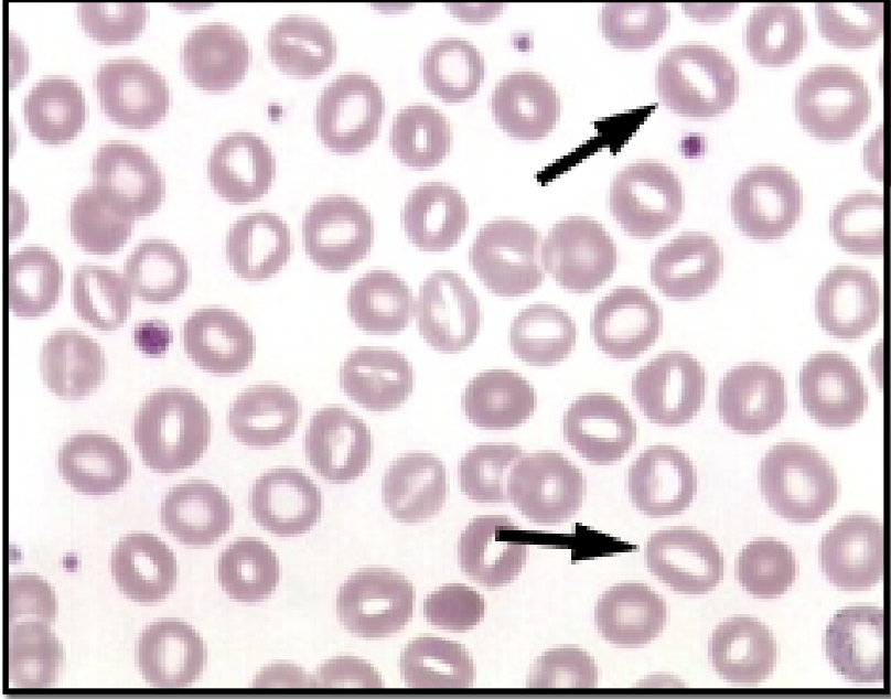 <p><strong>Smear Findings</strong>: few to many stomatocytes</p><p><strong>MCV</strong>: 82-98</p>