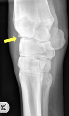 <p>How do you treat carpal chip fractures?</p>
