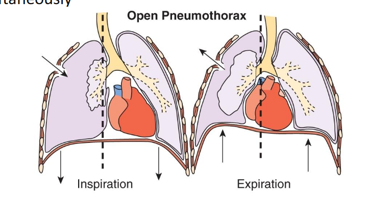 <ul><li><p class="Paragraph SCXO214892787 BCX0" style="text-align: left;"><span style="background-color: inherit; line-height: 20.7px; color: windowtext;">Presence of air in the pleural space caused by a rupture in the visceral or partial pleura. Air pushes on the outside of the lung and makes it collapse </span><span style="line-height: 20.7px; color: windowtext;"> </span></p></li><li><p class="Paragraph SCXO214892787 BCX0" style="text-align: left;"><span style="background-color: inherit; line-height: 20.7px; color: windowtext;">Treatment involves inserting a needle or chest tube between the ribs to remove the excess air; a small pneumothorax may heal spontaneously</span><span style="line-height: 20.7px; color: windowtext;"> </span></p></li></ul><p></p>