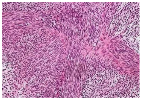 <p>Fibrosarcoma:C.S</p>
