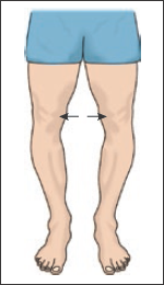 <p>Bowlegged; the space between the knees is abnormally increased and the lower leg bows outwardly</p>