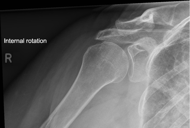 <p>correct rotation is evidenced by lesser tubercle in profile on medial side, open subacromial space (due to caudal angle) </p>
