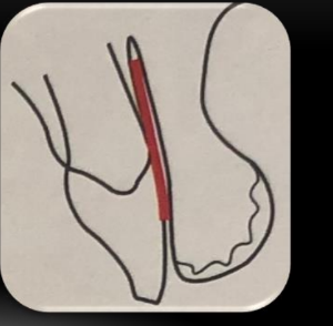 <p>-upper half of labial contour is in line with alveolar contour</p><p>-could be determined on the casts (IF casts properly record the vestibule)</p>