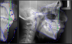<p>what distance measurement:</p><p>- Nasion-B Point to the lower incisors</p><p>- AP relationship between the cranial base, mandible, and the lower incisors</p><p>- Measured from the incisal edge of the lower incisor to Nasion-B Point along a perpendicular line</p><p>- If L1 is anterior to NB, the measurement is positive</p><p>- If L1 is posterior to NB, the measurement is negative</p><p>- Tells you about the horizontal position of the lower incisors</p>