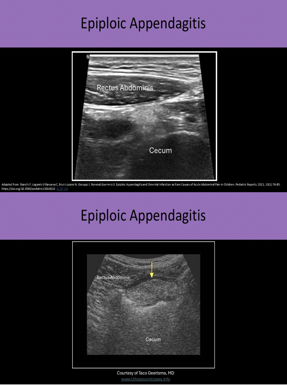 <p>D. inflammation of the thick fatty strands that attach to the serosal surface of the colon</p><p>Epiploic appendages are thick fatty strands that attach to the serosal surface of the colon. Torsion or thrombosis of these strands can cause ischemia or infarction. This leads to localized inflammation and pain. On US it appears as an echogenic finger-like projection from the colon wall. The surrounding pericolic fat becomes thickened and echogenic. It can simulate appendicitis and it is very important to differentiate the two because the treatments are very different.</p>