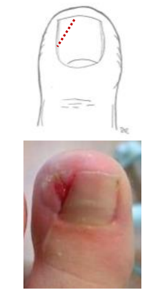 <p>Need to do digital block</p><p>Next take wedge out of the nail</p><ul><li><p>Scissors or hemostat </p></li><li><p>Slowly advance, lift plate </p></li><li><p>Wedge removal nail </p></li><li><p>Grasp nail firmly </p></li><li><p>Remove from nail bed</p></li></ul><p>Use phenol if available to kill ingrown nail root</p>
