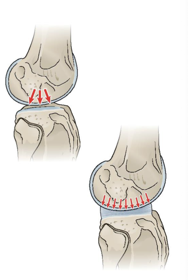 <p><span>Roles:</span></p><ul><li><p><span>Increase the concavity of the<br>tibial articulating surfaces</span></p><ul><li><p>good for femoral condyles </p></li></ul></li><li><p><span>Distribution of WB’ing forces</span></p><ul><li><p><span>Stress → gives wider surface area → low WBing stress to hyaline cartilage</span></p></li></ul><p></p></li><li><p><span>Reducing friction between articulating surfaces (tibia + femur) </span></p></li></ul><p></p><ul><li><p><span>Shock absorbers to decrease load on articular cartilage (can<br>assume over 50% of load)</span></p></li></ul><p></p>
