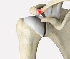 <p><span style="background-color: transparent;"><strong>What is the name of the injury shown in the picture below?</strong></span></p>
