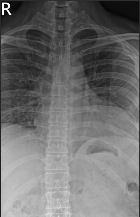 <p>Is this film of diagnostic quality (AP Thoracic)</p>