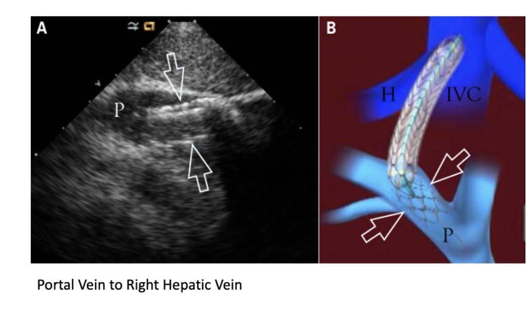 <p>What is TIPs, what will we see on ultrasound,</p>