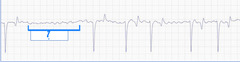 <p>What is this called in Atrial fibrillation?</p>