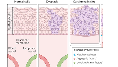<p><span>full thickness dysplasia of the epithelium</span></p>