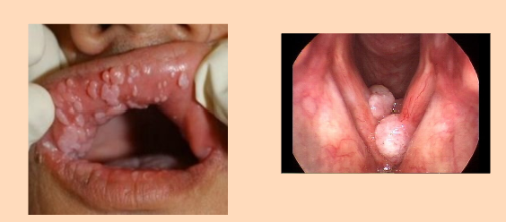 <p>Human papillomavirus or HPV</p>