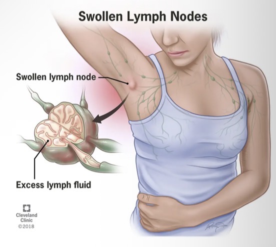 <ul><li><p>the formation of lymphocytes increases and more macrophages rush to the area to kill pathogens</p></li><li><p>This results in the lymph nodes becoming swollen and sore</p></li></ul><p></p>