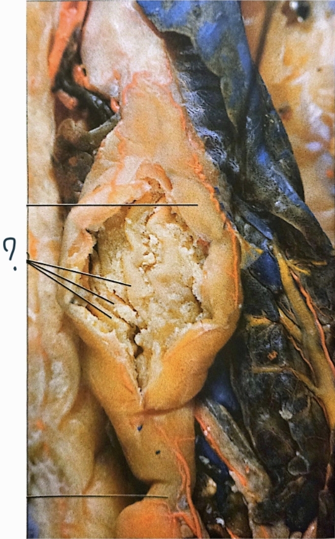 <p>inside the stomach; straited lines or chunky filling or folded ridges; allows the stomach to distend/expand when filled with food also increases surface area for digestion and chemical breakdown</p>