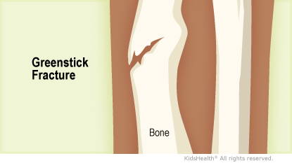 <p>bend and crack, does not break all the way through </p>