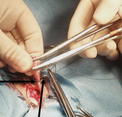 <p>What kind of ligature is being placed above the circumferential?</p>