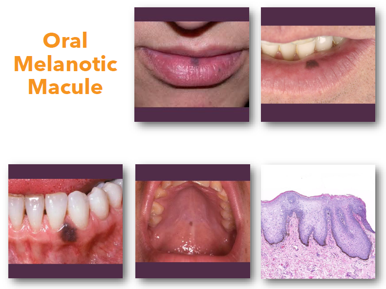 <p>oral melanotic macule: management and prognosis </p>