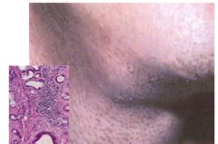 <p>Active infection such as colds or sore throats.</p>