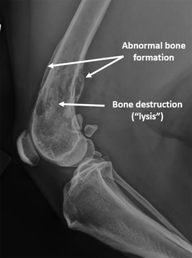 <p>Osteosarcoma (Bimodal Age Incidence)</p>