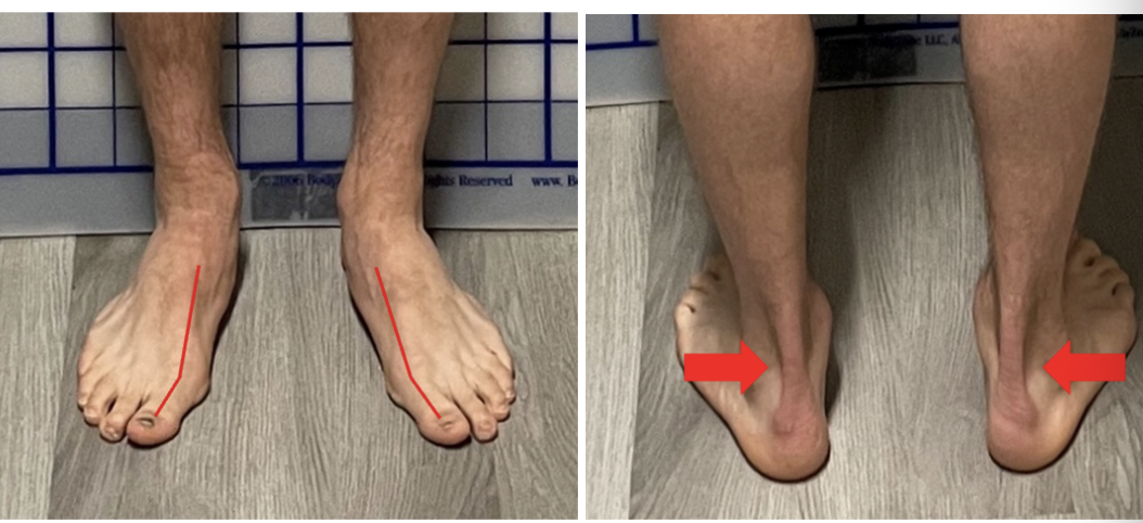 <p>Collapsed arches &amp; Big toe valgus: reason/why</p>