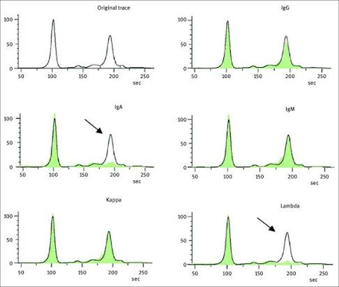 <p>Capillary electro is used to check for monoclonal Ig</p><ul><li><p>Antisera is added to patient serum</p></li><li><p>If antisera binds to a monoclonal Ig, peaks in the chart will disappear</p></li></ul><p></p><p>In the picture the patient is green → the line is control </p><ul><li><p>Patient green peak disappeared in kappa and lambda </p></li></ul><p></p>