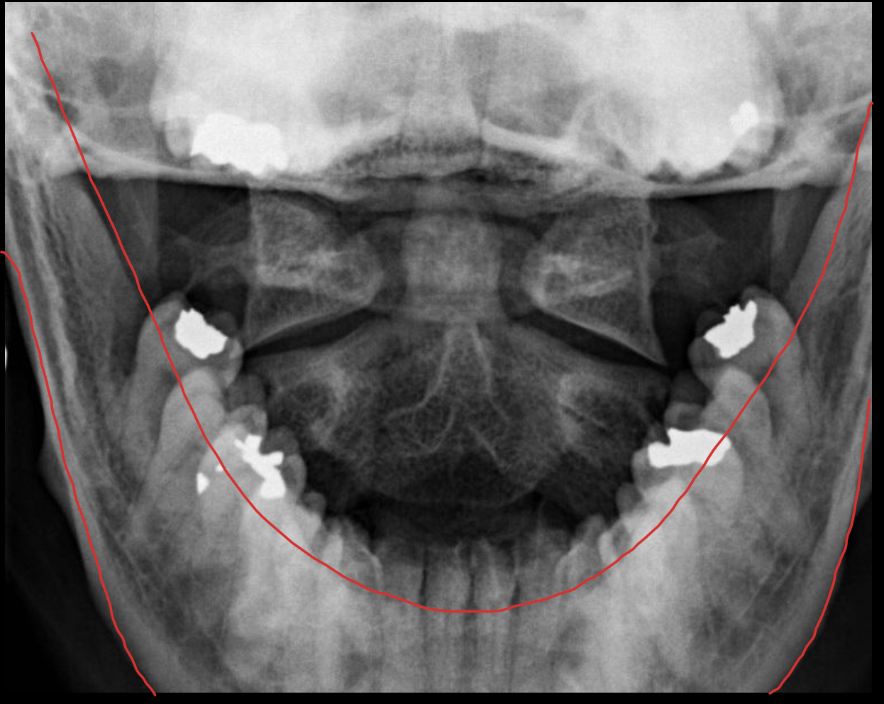<p><span>下颌骨</span></p>