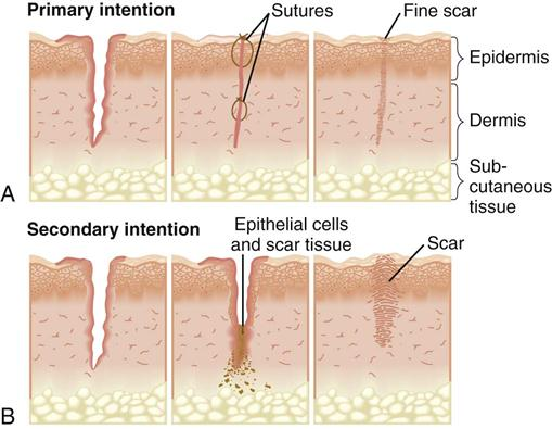 <p>The surgical technique used to bring the edges of a wound together to promote healing and minimize scarring. </p><ul><li><p>This process often involves sutures or other closure methods to ensure the wound edges are aligned properly.</p></li></ul><p></p>