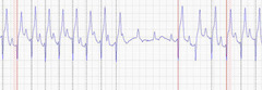 <p>Describe this ECG during exercise</p>