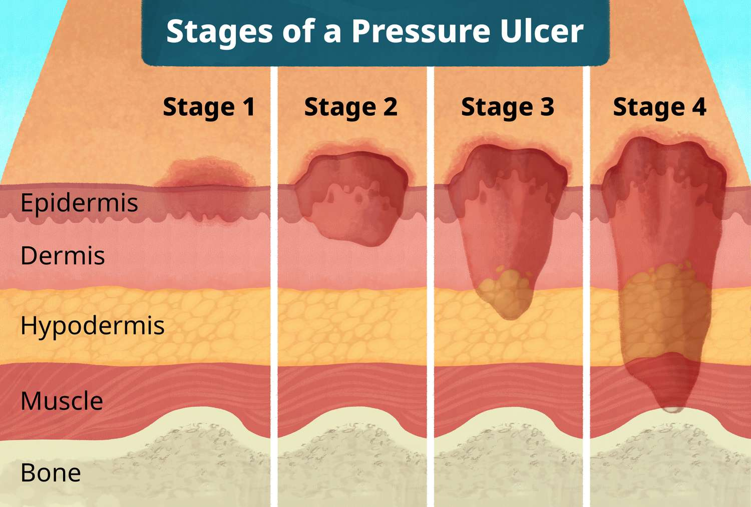 <p><strong>Partial-thickness skin loss</strong>; shallow ulcer or intact/ruptured blister.</p>