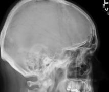 <p><span style="background-color: transparent;">Lateral skull</span></p>
