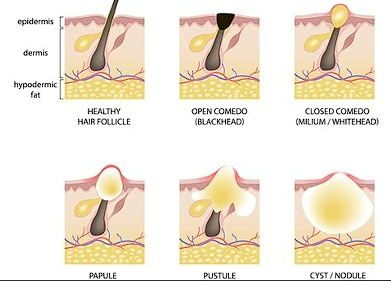 <ul><li><p>Follicle becomes plugged</p></li><li><p>Follicular wall ruptures</p></li><li><p>Contents spill into dermis causing inflammation</p></li></ul><p></p>