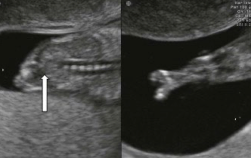 <ul><li><p>variable fusion of the lower extremities</p></li><li><p>bilateral renal agenesis</p></li><li><p>oligohydramnios</p></li><li><p>single umbilical artery</p></li></ul><p></p>